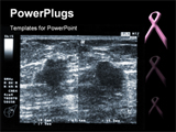 PowerPoint Template - a typical founding of breastcancer in ultrasound examination